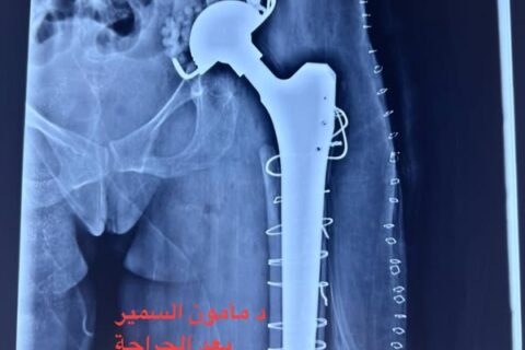إعادة تبديل مفصل ورك (ريفجن ورك )