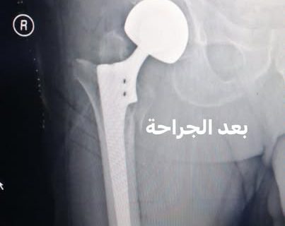 تبديل مفصل ورك بمفصل تعويضي