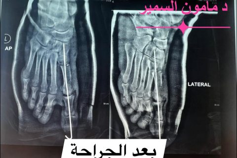 الإبهام الأفحج