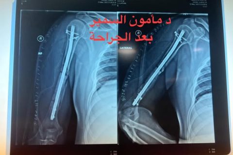 كسر العضد