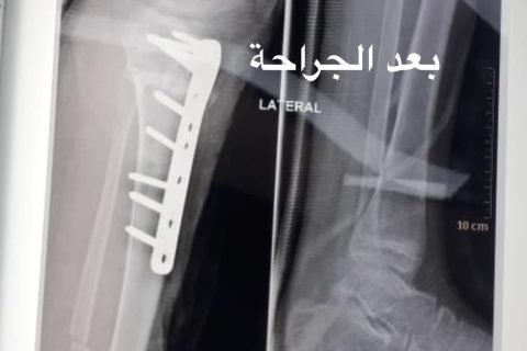 اصلاح تشوه محور الركبه بالخزع العظمي