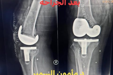 علاج الخشونة المتقدمة للركبة