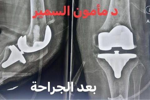 تنكس مفصل الركبة
