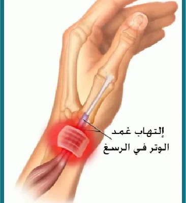 التهاب دي كيرفان