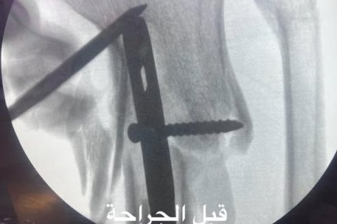 كسر في أعلى الساق  مثبت بشكل خاطئ