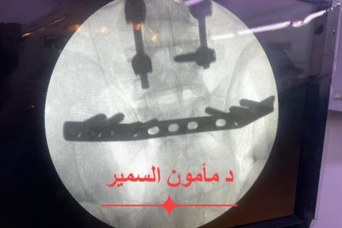 اصلاح كسر جوف حقي جدار أمامي وجدار خلفي