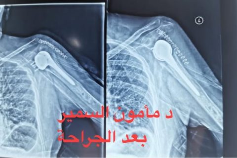 تبديل مفصل الكتف